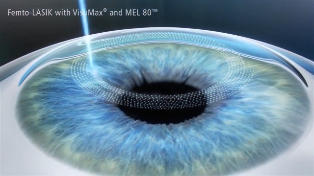 femto lasik